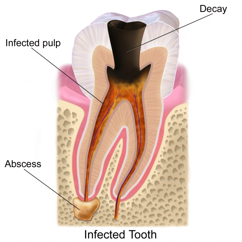 Pulpitis - Risk of tooth loss | Nha Khoa Minh Khai