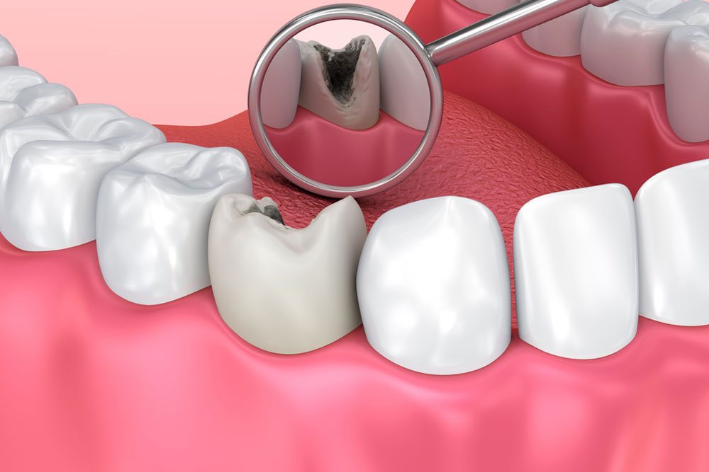 Tìm hiểu về răng sứ quy trình làm răng sứ diễn ra như thế nào?
