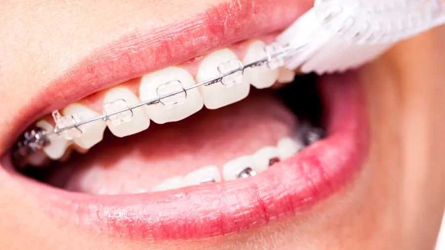 Chăm sóc răng niềng quan trọng như thế nào?