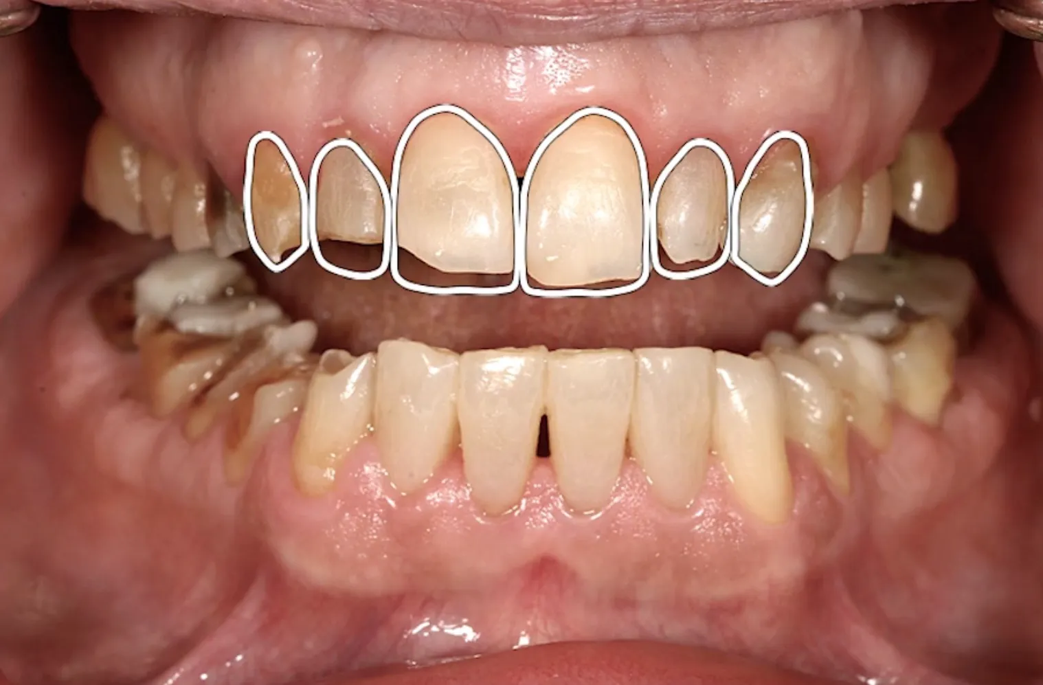 Nghiến răng khi ngủ cũng là một trong các nguyên nhân chính gây mòn răng