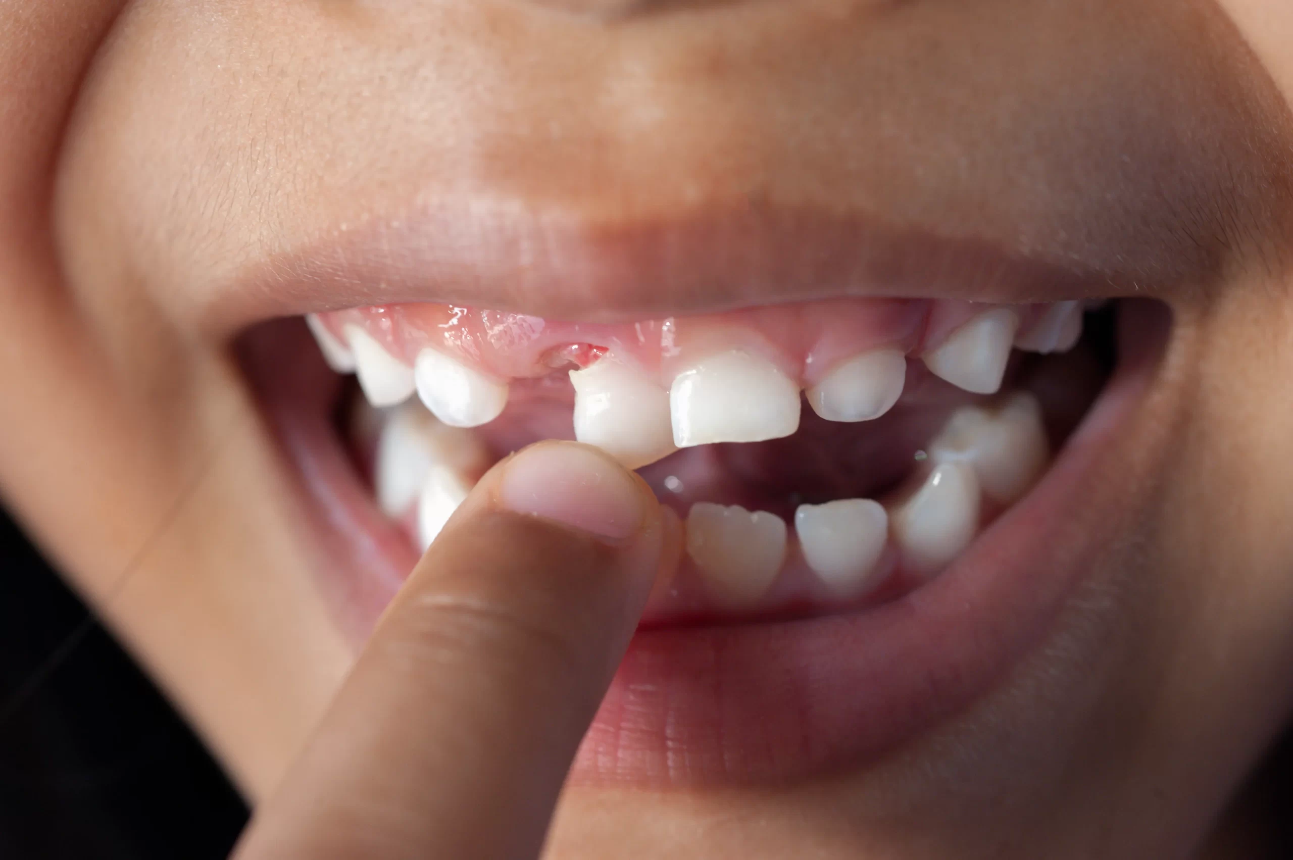 Các nguyên nhân khiến răng bị lung lây là gì?