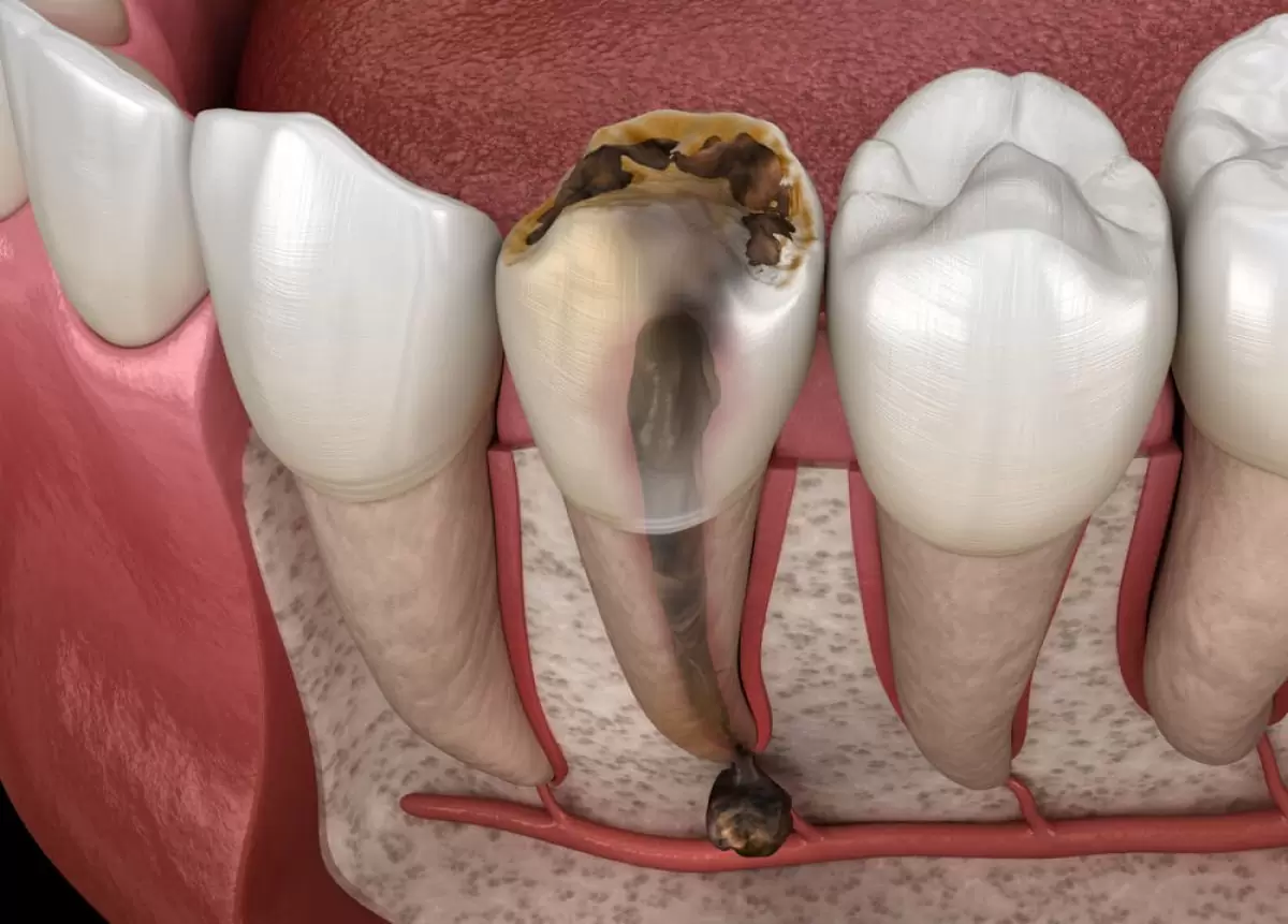 RĂNG CHẾT TỦY ĐỂ LÂU CÓ THỂ GÂY NHIỄM TRÙNG VÀ TIÊU XƯƠNG QUANH CHÂN RĂNG